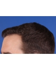 After Hair Transplant &nbsp;Hairlines